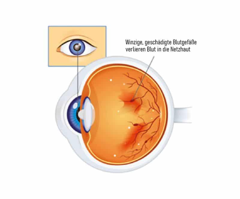 uecker-augenoptik-netzhautscan-diabtische-retinopathie-unnormal