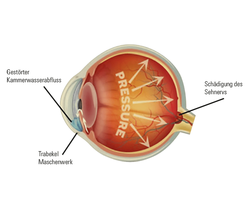 uecker-augenoptik-netzhautscan-glaukom-unnormal.jpg