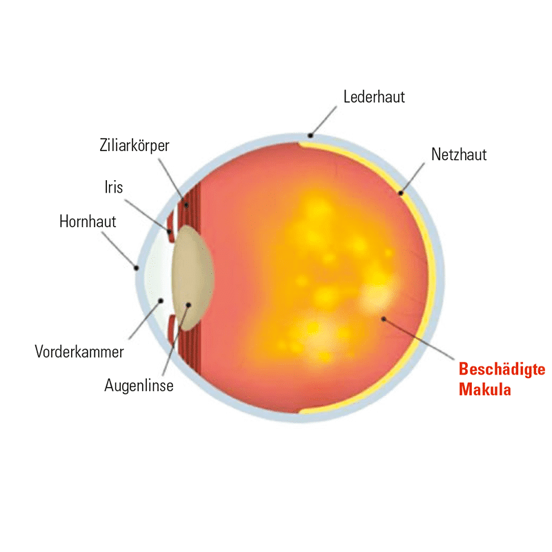 uecker-augenoptik-netzhautscan-makuladegeneration-unnormal.jpg