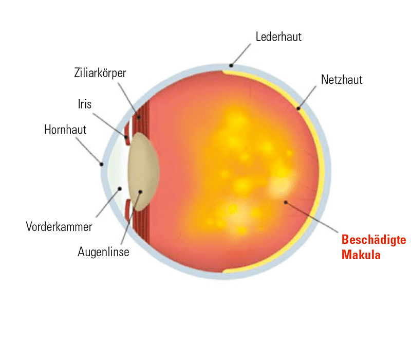 uecker-augenoptik-netzhautscan-makuladegeneration-unnormal-neu